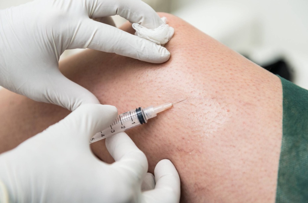 Secagem de Vasinhos na NeoSkin Uberlândia - Procedimento PEIM para pernas lisinhas